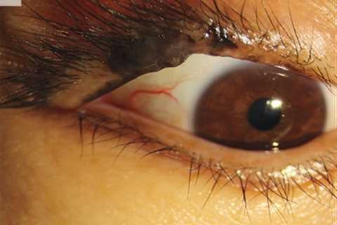 Shocking images show skin cancer in your EYE – the 7 signs to watch out for