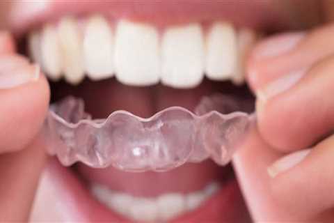 What is the last stage of invisalign?