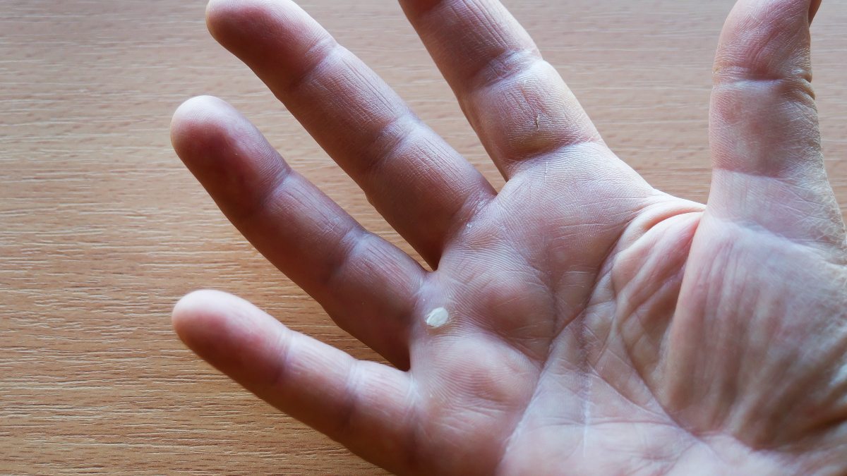 Ask the Experts: 'I Was Gardening and Got What Looks Like a Callus, But It's Not. What Is It?'