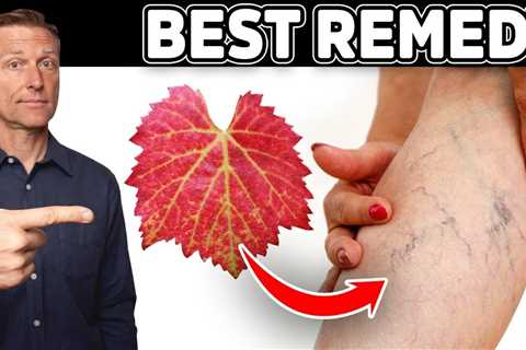 The #1 Remedy for Varicose Veins (Venous Insufficiency) - Dr. Berg