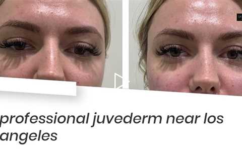 Juvederm in Los Angeles by Skinsation LA (323) 413-2287