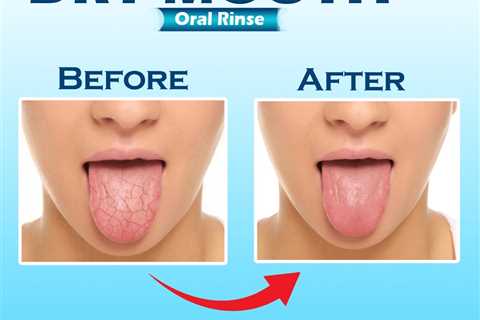 cure dry mouth naturally