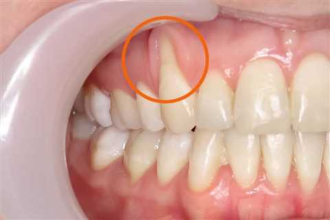 How To Regrow Receding Gums?