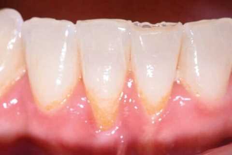 How To Reverse Gingivitis And Receding Gums?