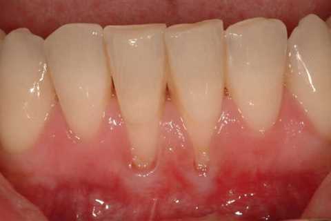 Receding Gums Reverse