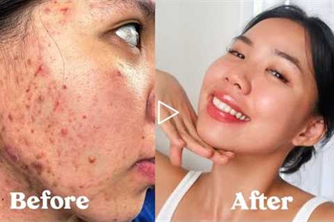 (ENG SUB) HOW I GOT RID OF MY ACNE, SCARS, TEXTURE & HYPERPIGMENTATION  *not sponsored*