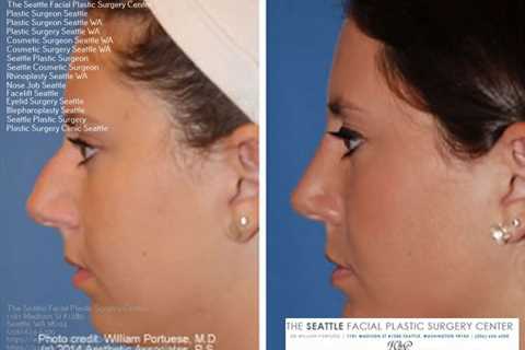 best rhinoplasty surgeon seattle | Rhinoplasty surgeon, Facial plastic surgery, Rhinoplasty