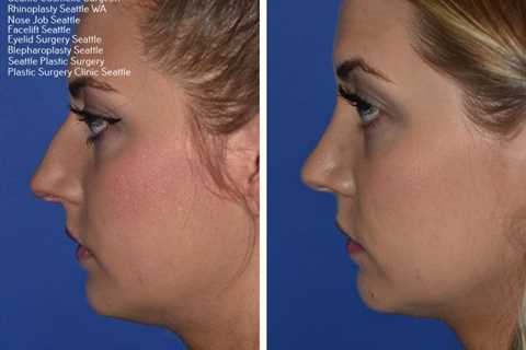 best place to get rhinoplasty in usa | Rhinoplasty, Botox, Facial plastic surgery