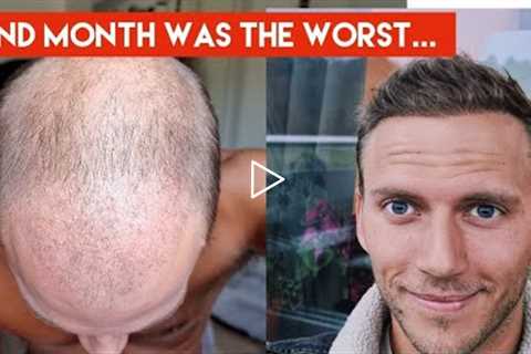 My Hair Transplant Journey - The AWFUL first 4 months (in-depth walkthrough week by week)