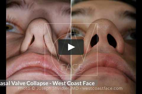 Nasal Valve Collapse - Rhinoplasty in Seattle WA