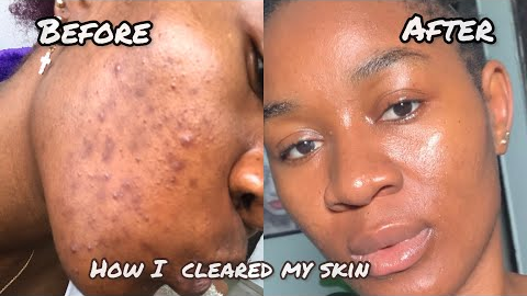 HOW I CLEARED MY SKIN.. MY SIMPLE SKIN CARE ROUTINE #skincare