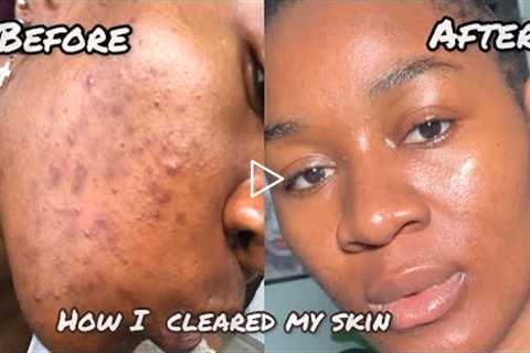 HOW I CLEARED MY SKIN.. MY SIMPLE SKIN CARE ROUTINE #skincare