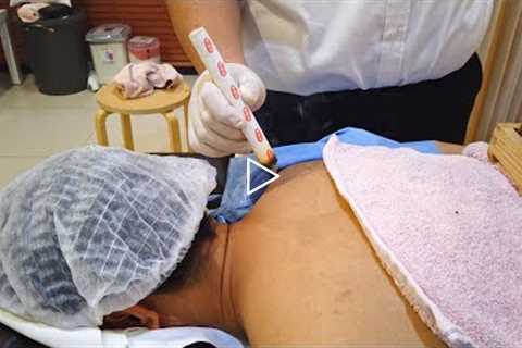 Unreal CHINESE MEDICAL THERAPY That Relieve Back & Shoulder Pains (Moxibustion)