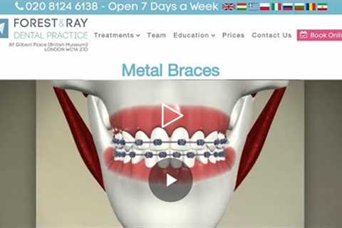 Metal Braces London - Forest & Ray - Dentists, Orthodontists, Implant Surgeons