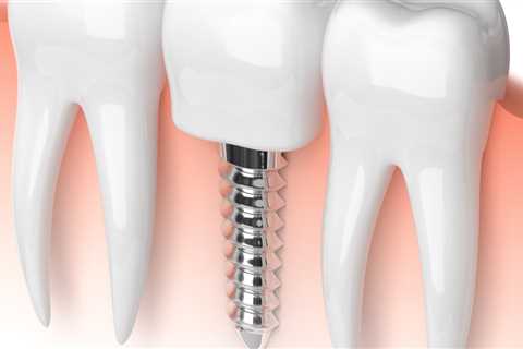 How dental implants work?