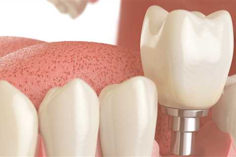 Where does the bone come from for dental implants?