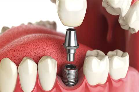 Can dental implants make you sick?