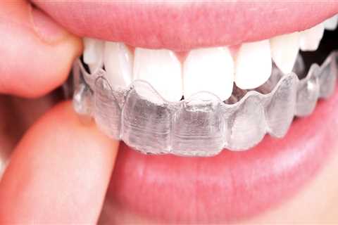 Do aligners work as well as braces?