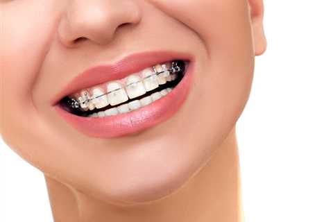 What you Might Not Know about Dental Braces – Health Plus Cogni