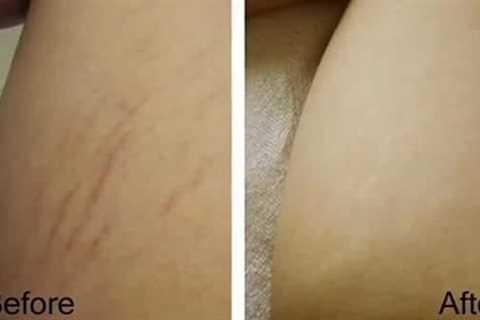 Does Mederma Stretch Marks Therapy Really Work?