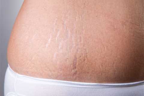 Laser Therapy to Remove Stretch Marks