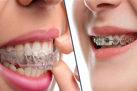 The Benefits of Clear Aligners Over Braces