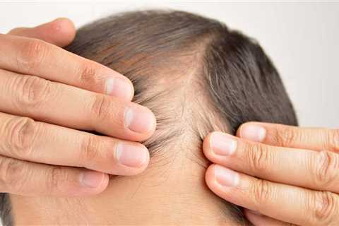 The Recent Increase in Men’s Hair Restoration