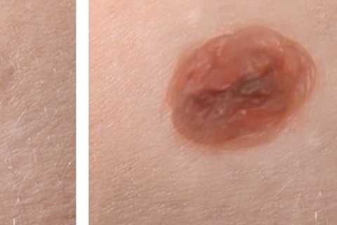 How to Prevent Infection After Mole Removal Surgery