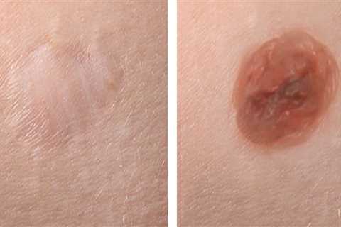 The Dangers of Long-term Skin Damage from Mole Removal