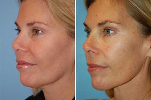 Face and Neck Liposuction Seattle Washington