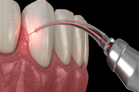 What kind of lasers do dentists use?