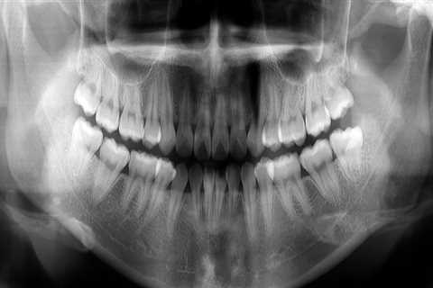 When are dental x rays necessary?