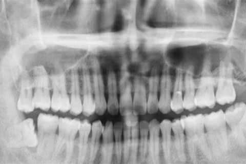 What is a full mouth x-ray called?