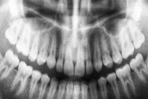 Should dental xrays hurt?