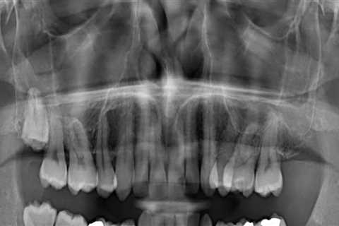 Are dental x rays dangerous?