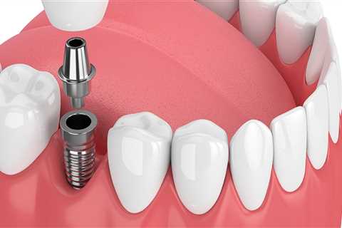 Modern Dental Implants Explained By A Professional Dentist In Taylor, Texas