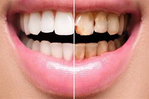 How long do veneers take to feel normal?