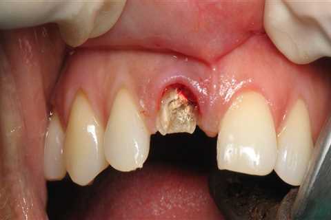 How long does a dental implant take from start to finish?