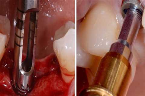 Can dental implants be removed?