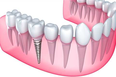 What You Need To Know About Dental Implants In Borger