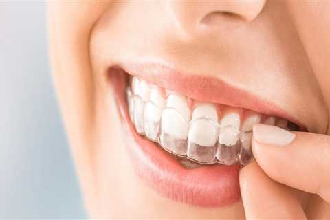 Can Clear Aligners Give You a Perfect Smile?