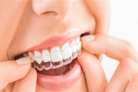 How Long Does Treatment with Clear Aligners Take?