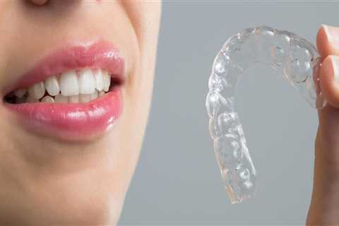 Where to Find Clear Aligners for a Perfect Smile