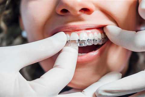 Don’t DIY Your Invisalign – Here’s Why