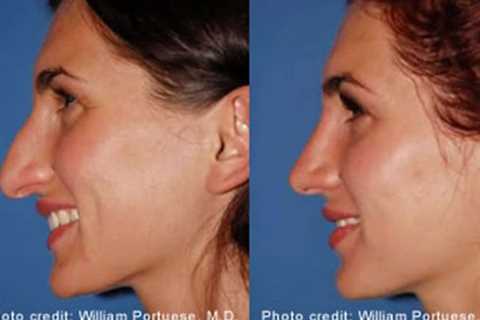 The Portland Center for Facial Plastic Surgery : Rhinoplasty, Facelift Surgery