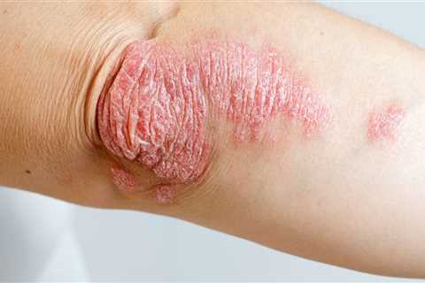 Psoriasis: A Comprehensive Overview of Causes, Symptoms, and Treatments