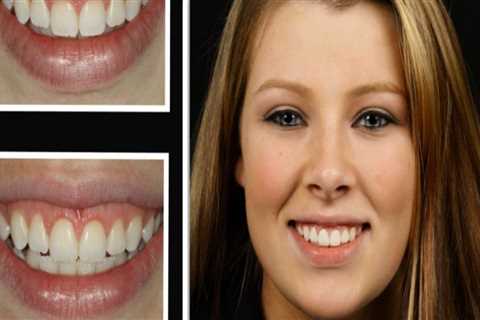 Can Laser Dentistry Help Treat Cavities and Improve Oral Hygiene?