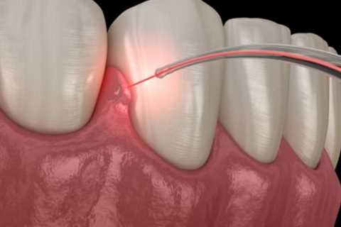 How Often Should You Brush and Floss After a Dental Laser Cleaning?