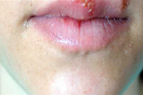 Painful Sores or Blisters on the Skin: Signs, Causes, and Treatments