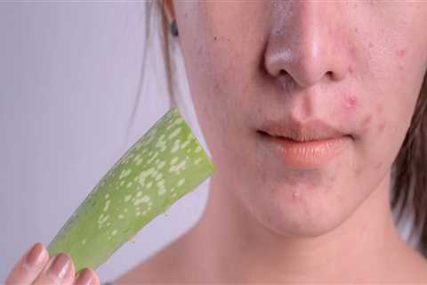 Aloe Vera For Acne Scars: Everything You Need To Know